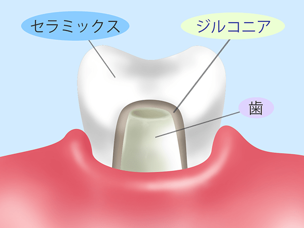 フルジルコニアクラウン（被せ物）