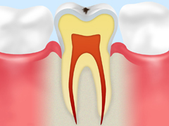 CO～初期のむし歯～