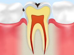 C1～エナメル質のむし歯～