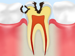C2～象牙質のむし歯～