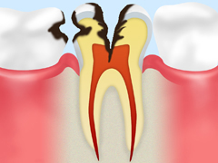 C3～神経に達したむし歯～