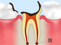 C4～歯の上の部分（歯冠）がほとんど溶けてしまったむし歯～