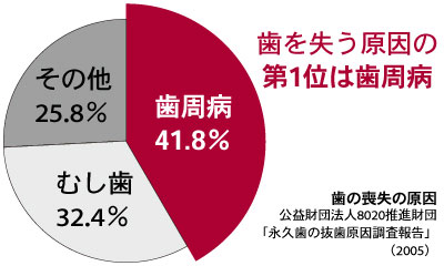 歯周病は歯を失う原因の第1位