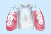 金属床義歯（チタン）