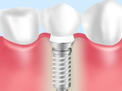インプラント上部構造