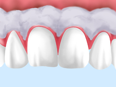 ガムピーリング歯ぐきのホワイトニング）